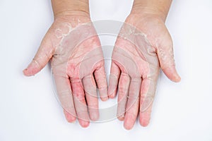 The Dry hands, peel, Contact dermatitis, fungal infections, Skin inf