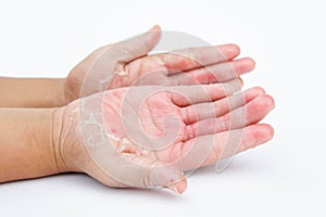 The Dry hands, peel, Contact dermatitis, fungal infections, Skin inf photo