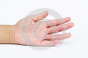 The Dry hands, peel, Contact dermatitis, fungal infections, Skin inf