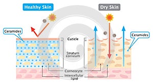 Dry and healthy skin layer illustration. skin care concept photo