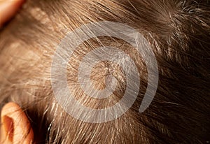 Dry itchy dandruff  scalp with scabs on woman`s head with hair