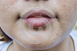 Dry lips, Lack of skin lips maintenance