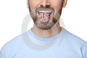 Dry mouth symptom. Man showing dehydrated tongue on white background, closeup