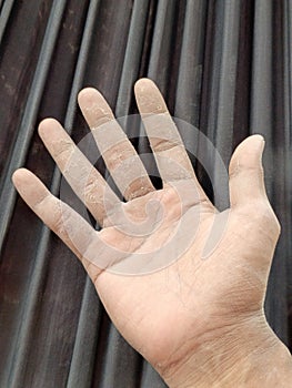 Dry, peeling skin on hand, showing texture and need for moisturizer