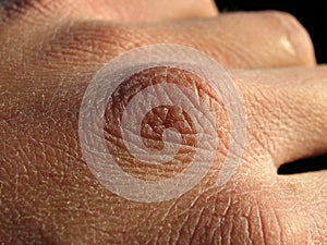 Dry skin