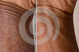 Dry skin in the arm of an African boy before and after using a moisturizer