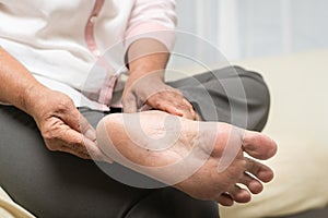 Dry skin and cornea on senior woman foot photo