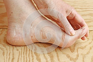 Dry skin and cornea on toes and heel of a woman photo