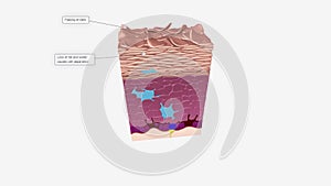 Dry Skin in Epidermis The stratum corneum is the outermost layer of the epidermis.