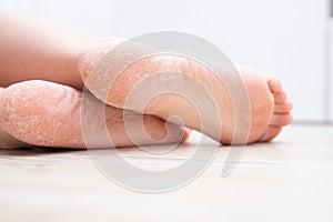 The dry skin on the feet is cracked. Treatment concept with moisturizing creams and exfoliation for healing wounds and