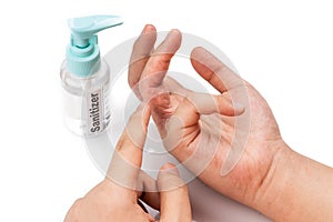 Dry skin finger with bottle of hand sanitizer. Sanitizer causes dryness with frequent use
