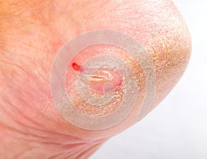 Dry skin on heel