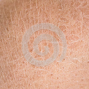 Dry skin (ichthyosis) detail