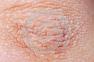 Dry skin or ichthyosis texture detail. Extreme close up macro shot dehydration skin.