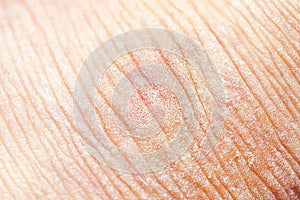 Dry skin or ichthyosis texture detail. Extreme close up macro shot dehydration skin.