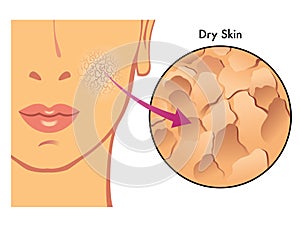 Dry skin photo