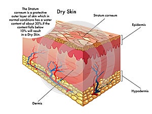 Dry skin photo