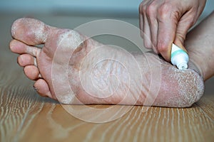Dry skin, plantar callosity and flakes on the female feet sole close up. Hand applying medicated ointment to heel