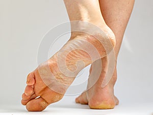 Dry skin, plantar callosity and flakes on female heel and feet sole close up