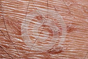 Dry skin texture