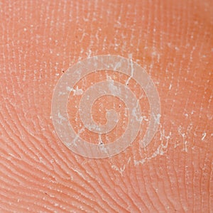 Dry skin texture