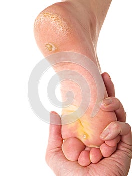 Dry skin under foot