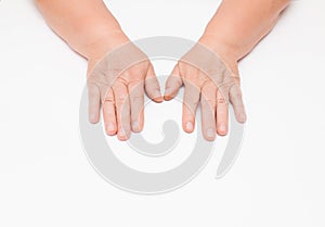 Dry skin with wrinkles on the hands of an elderly woman, white background, isolate. Fragility of blood vessels, vitamin deficiency