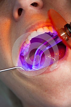 Drying of the dental filling