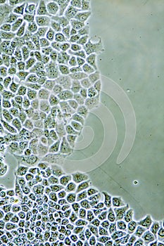 Ductal Breast Cancer cells