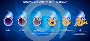 Ductal carcinoma development