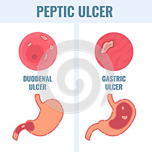 Duodenal and gastric types of peptic ulcer stomach disease