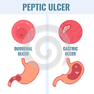 Duodenal and gastric types of peptic ulcer stomach disease photo