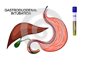 Duodenal sounding stomach, gaster, liver