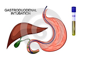 Duodenal sounding stomach, gaster, liver photo