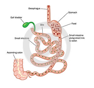 Duodenal switch bariatric surgery