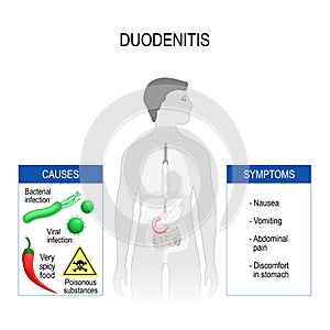Duodenitis. Symptoms and causes.