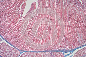Duodenum biopsy from the pathology of  small intestine