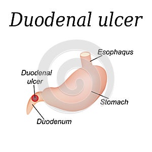 Duodenum ulcer affected. Duodenal ulcer. Vector illustration on a background of isolation