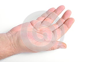 Dupuytren`s contracture, also called Dupuytren`s disease, Morbus Dupuytren, Viking disease, and Celtic hand. On white background photo