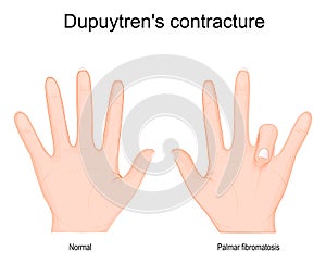 Dupuytren`s contracture. Comparison and difference of a healthy hand and Dupuytren`s disease in left hand