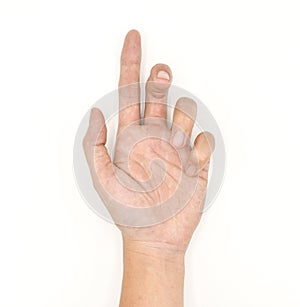 DupuytrenÃ¢â¬â¢s contracture in left hand of Asian young man. photo