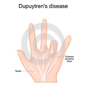 Dupuytrens disease. Human hand with Tendons