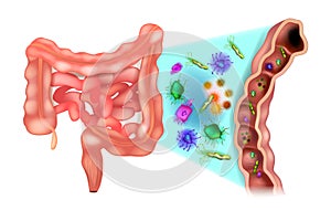 Dysbacteriosis of the intestine - Colon bacteria.