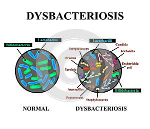 Dysbacteriosis intestine. Lactobacillus, Bifidobacteria, Streptococcus, Staphylococcus, E. coli, Aspergyllus mushrooms, Candida photo