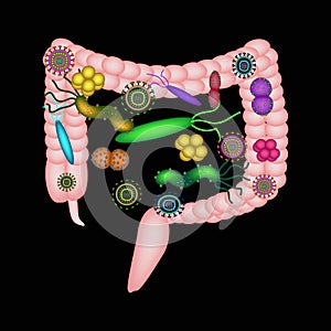 Dysbacteriosis of the intestine. The large intestine. dysbiosis of colon. Bacteria, fungi, viruses. Infographics. photo
