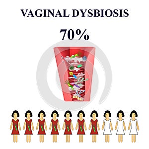 Dysbacteriosis of the vagina. Vaginitis. Candidiasis. 70 percent of women are ill. photo