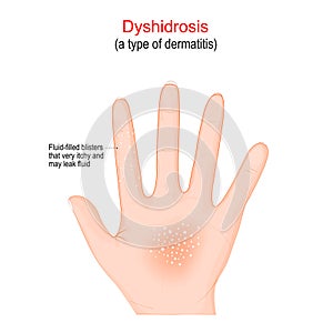 Dyshidrosis. type of dermatitis with itchy blisters on the palms
