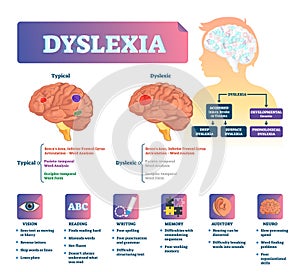 Dyslexia vector illustration. Labeled medical brain illness problem scheme. photo