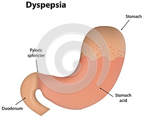 Dyspepsia