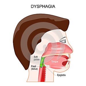 Dysphagia. aspiration food or liquid into the lungs